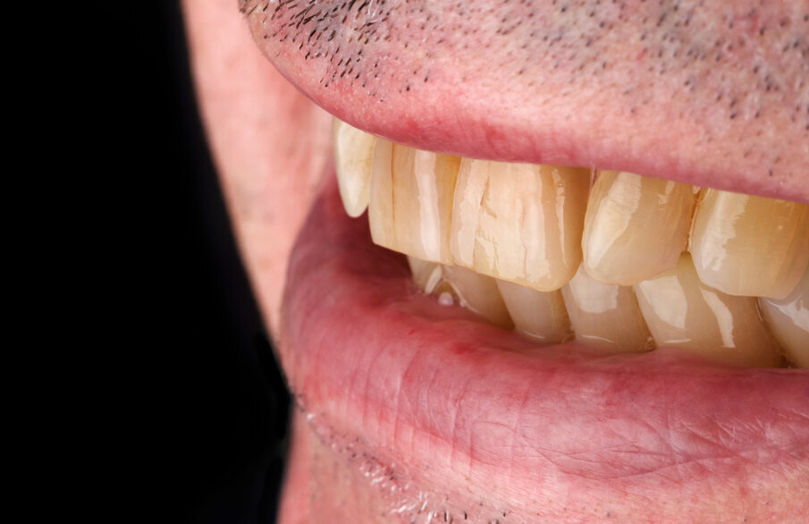 Fig.8: The shading and lighting of the restoration fits perfectly in the overall picture