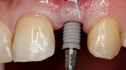 Implantologie-Update: Sofortversorgung und Platform Switching Implantologie-Update: Sofortversorgung und Platform Switching