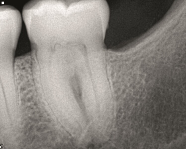 Fig. 8a : Radiographie préopératoire montrant la calcification pulpaire et la radioclarté au niveau de la zone de furcation. 