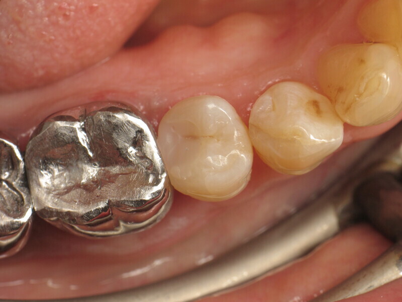 Fig. 22 : Restauration terminée après polissage.