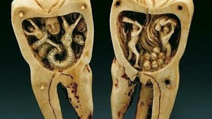L’origine del mal di denti e la nascita della devitalizzazione