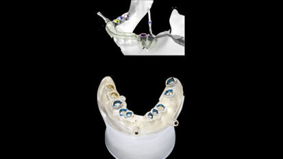 Webinar addresses digital workflow in implantology Webinar addresses digital workflow in implantology