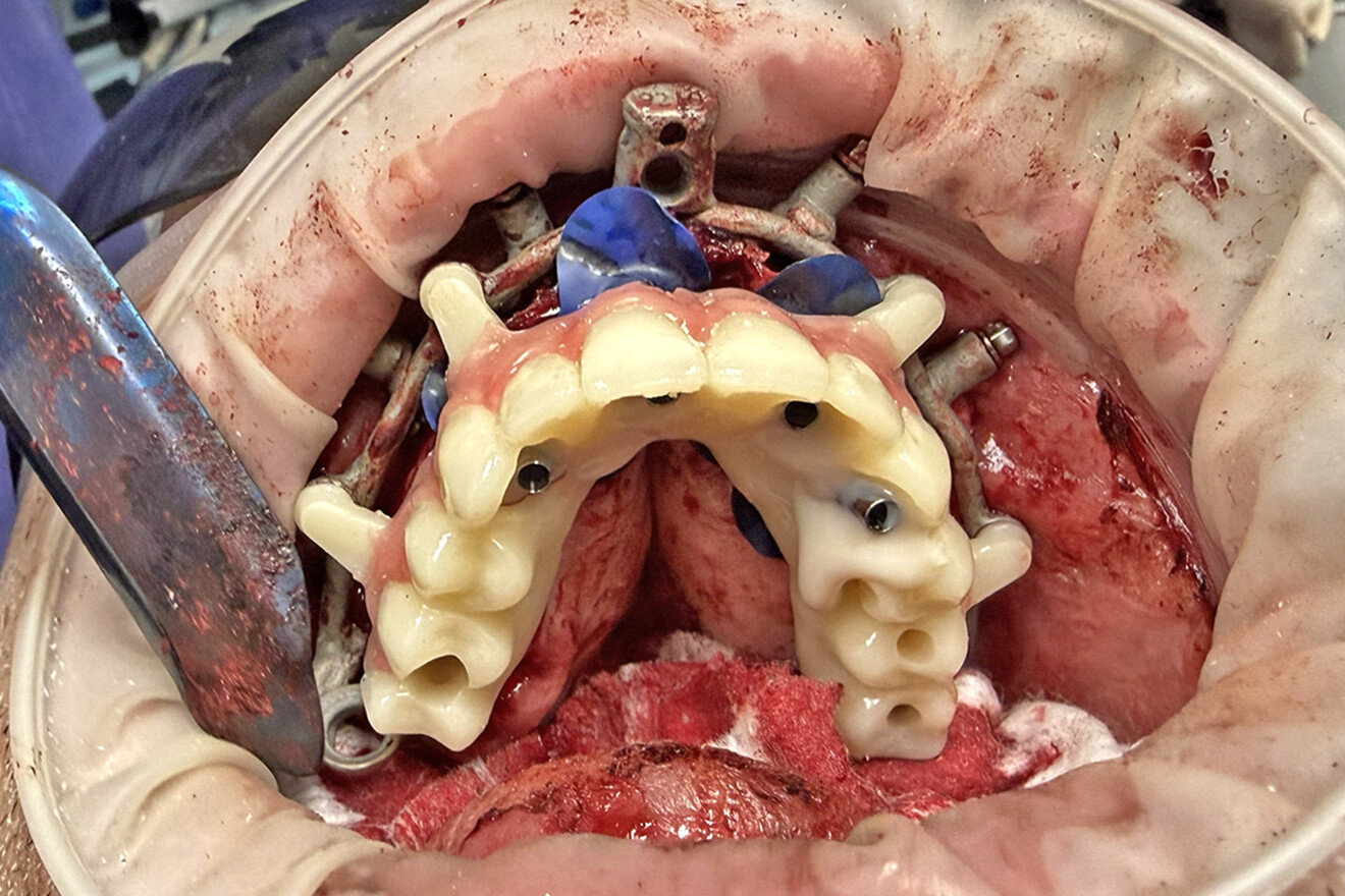 Fig. 22a: Retracted intra-oral oblique occlusal view of the provisional prosthesis attached to the base frame over the titanium cylinders. 