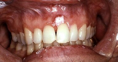 New gene test enables early oral cancer detection