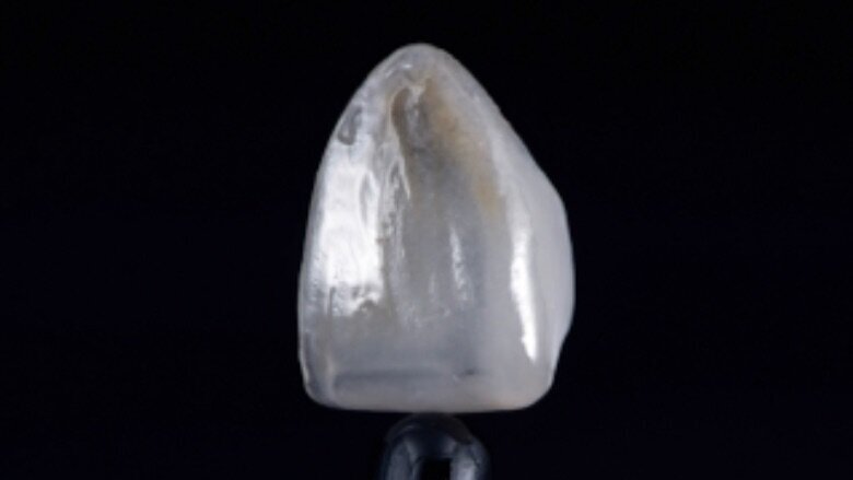 Fig. 5. Carilla caracterizada con maquillajes fotopolimerizables, antes de la colocación.