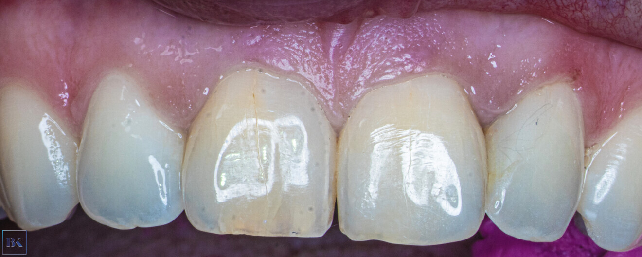 Fig. 14: Intra-oral view of the initial situation. Visible discoloration of the right central incisor.