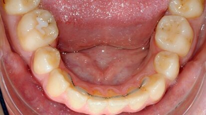 Procédure optimisée de collage d’un fil de contention