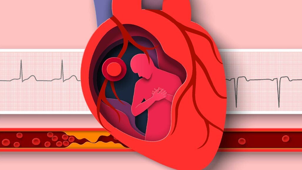 Unbehandelte Parodontitis kann zur Entzündung der Herzinnenhaut führen
