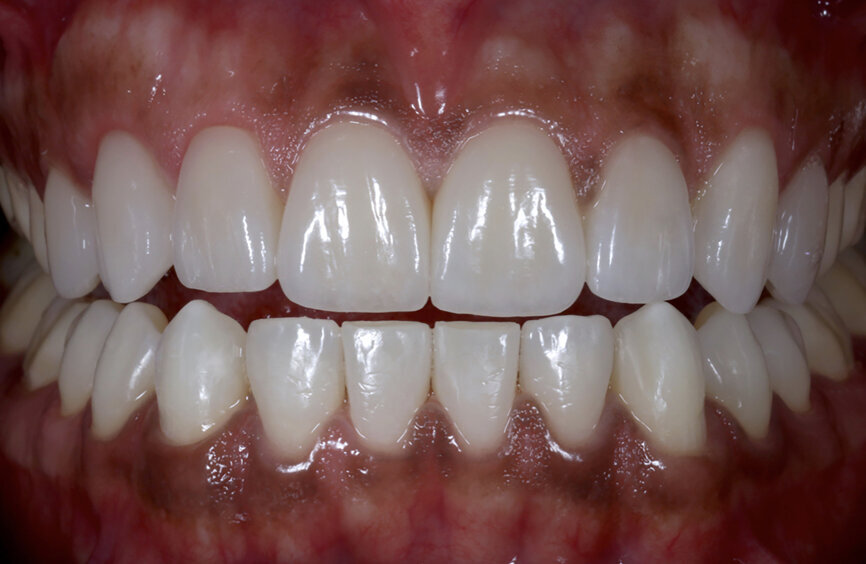 Fig. 81: Pre-op and post-op situations.