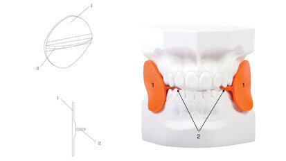L’abitudine muscolare  come elemento di recidiva: il cross-bite