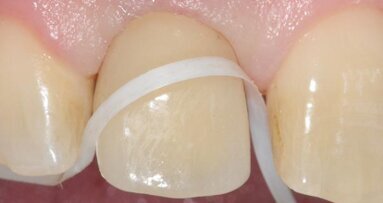 Maintenance of dental implants for the hygienist