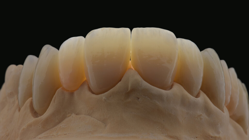 KATANA Zirconia restoration: Pretreatment for adhesive luting