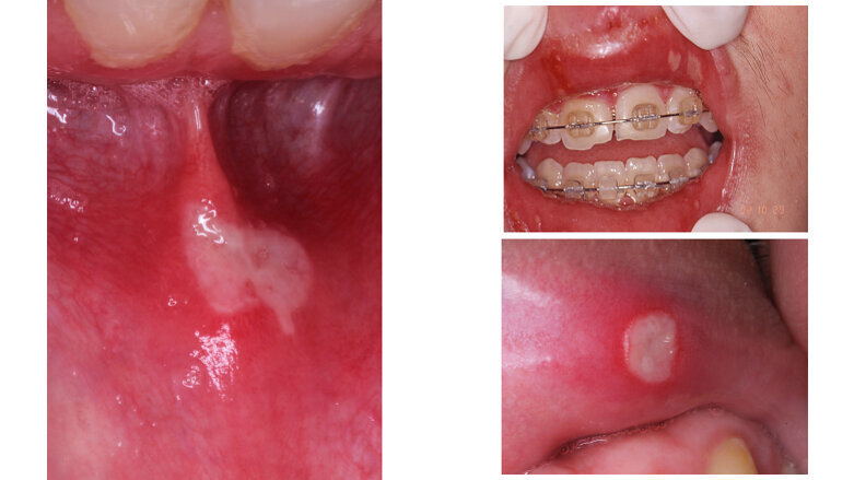 Aftas bucales. ¿Hay algo nuevo?