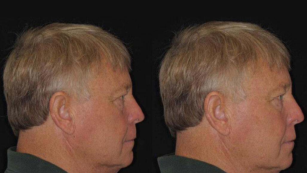 Проучване: не е нужно пациентите да правят компромис с външния си вид при избор на протеза