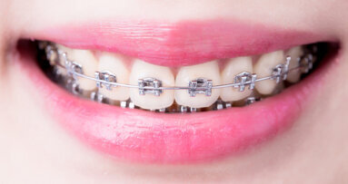 Zusammenhang zwischen Parodontitis und Zahnfehlstellungen