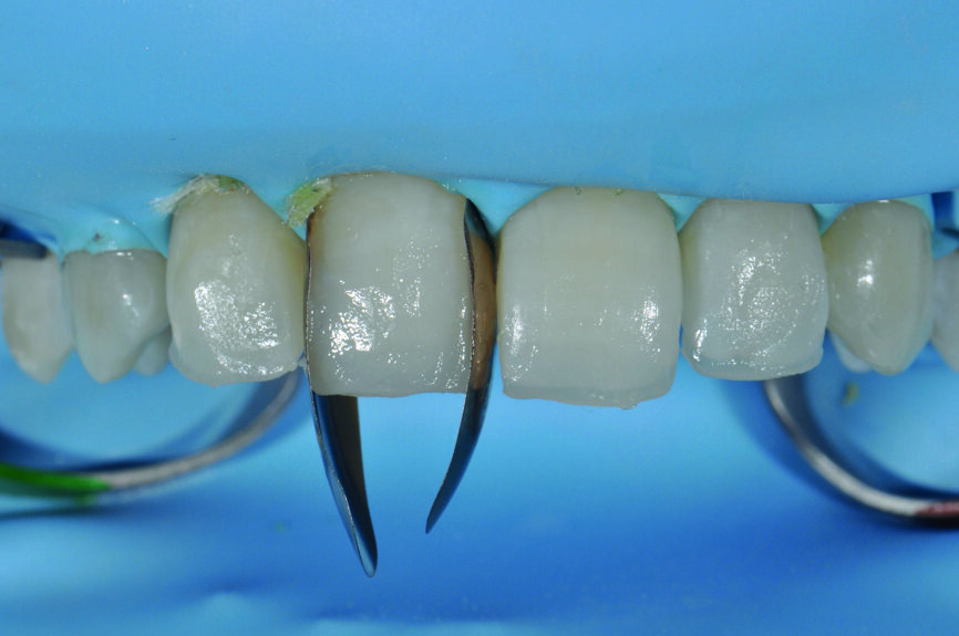 Fig 5 c) : La sélection des matrices et une mise en place adéquate sont importantes pour créer un profil d’émergence naturel. 