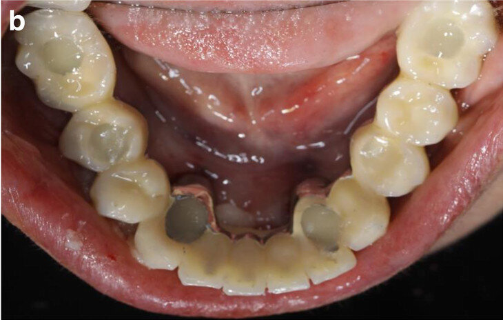Fig. 9b: Occlusal views of the abutments (a) and of the immediate provisional restoration that were passively bonded in situ (b).