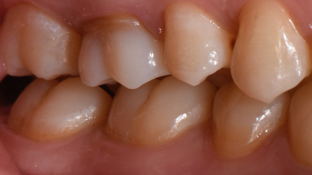 Fig. 31: Soft-tissue condition and optical integration of the restoration after two weeks.