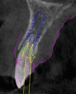Fig. 14 - Moncone SRA.
