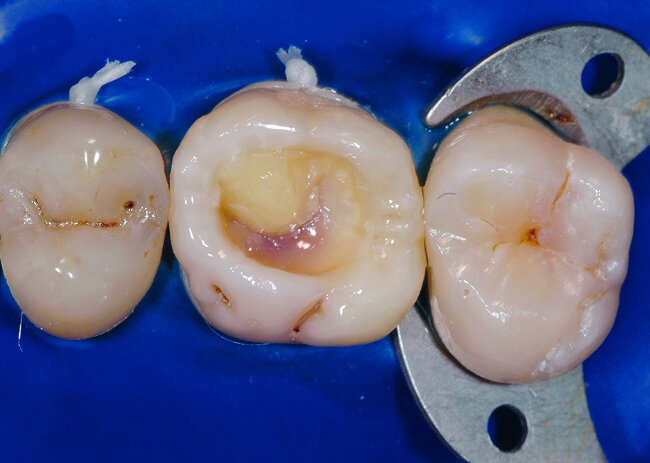 Fig. 24: Mise en place d’un premier incrément de composite de masse dentine. Chaque apport est applique sur la cavité en position oblique afin de jouer sur le facteur C.