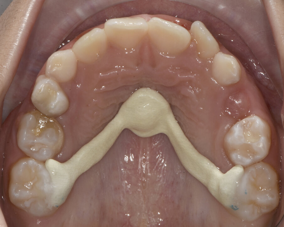 Fig. 18_Nance bondata e protocollo di estrazioni anticipate.