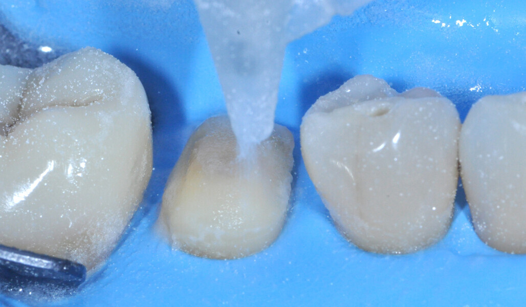 Fig. 14: Sandblasting of the tooth structure. 