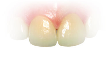 丙烯酸酯被评为“年度过敏原”