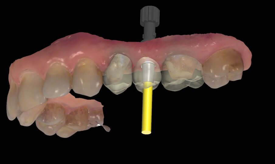 Fig. 12 - Una diversa inclinazione della stessa immagine con la diafania per evidenziare gli spazi a disposizione oltre alle forme anatomiche impostate.