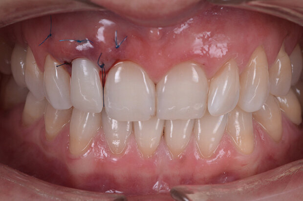 Fig. 12. Temporary restoration after the surgical intervention