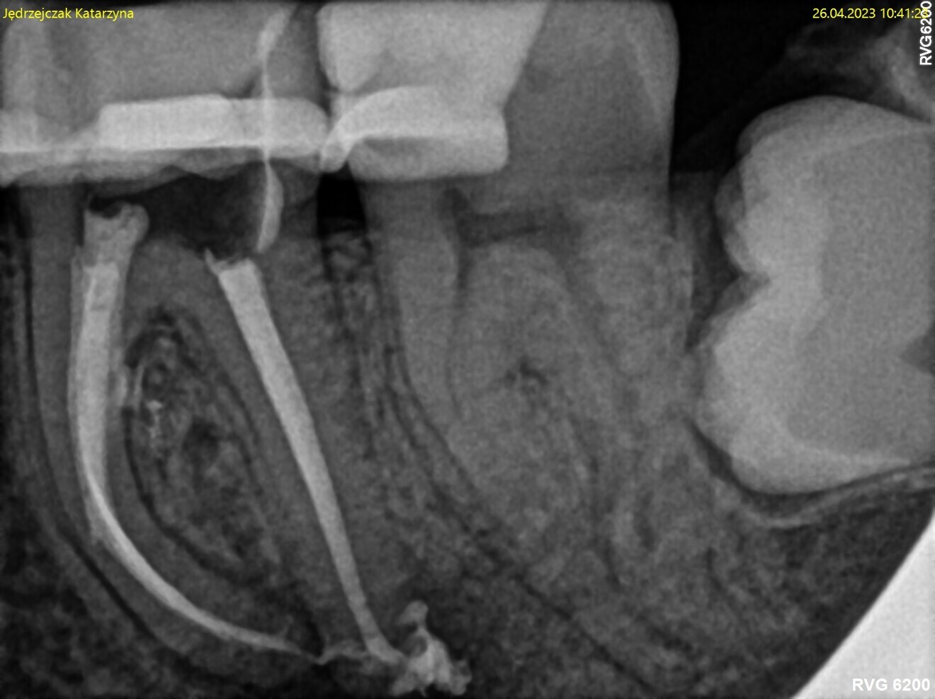 Fig. 10: Post-op radiograph. Puffs of the sealer visible.