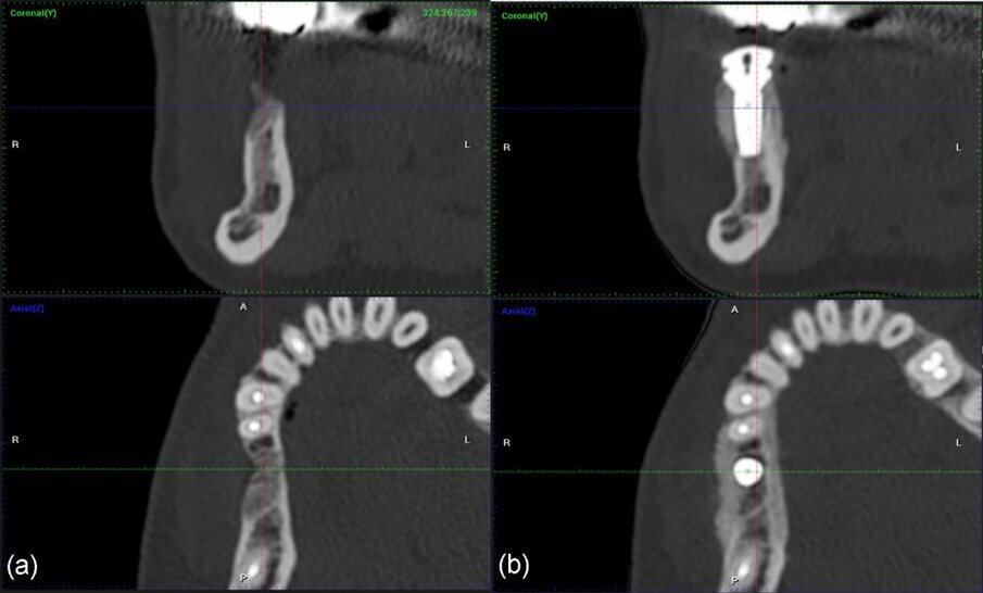 Fig. 25_a), b): Immagini coronali e assiali CBCT prima dell’intervento chirurgico e a 4 mesi dopo l’intervento.