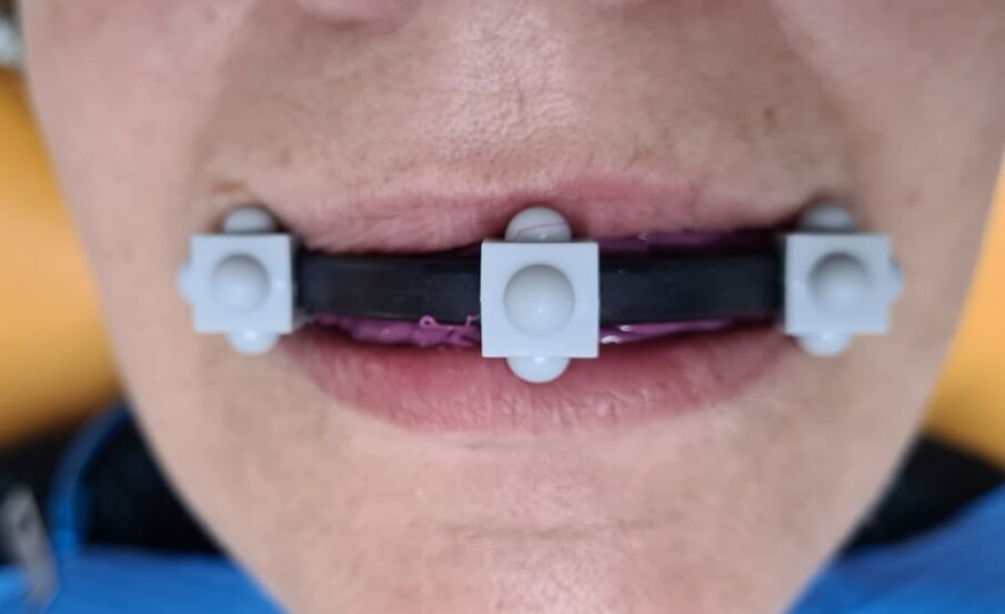Fig. 4_Dime radiologiche con stent per eseguire TAC.
