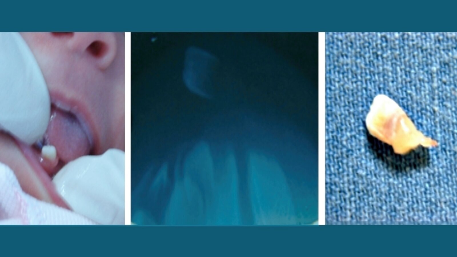 Tratamiento de dientes natales y neonatales