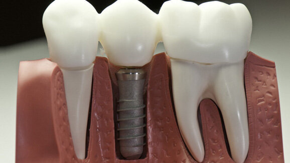 Bessere Osseointegration durch Speichelpeptide