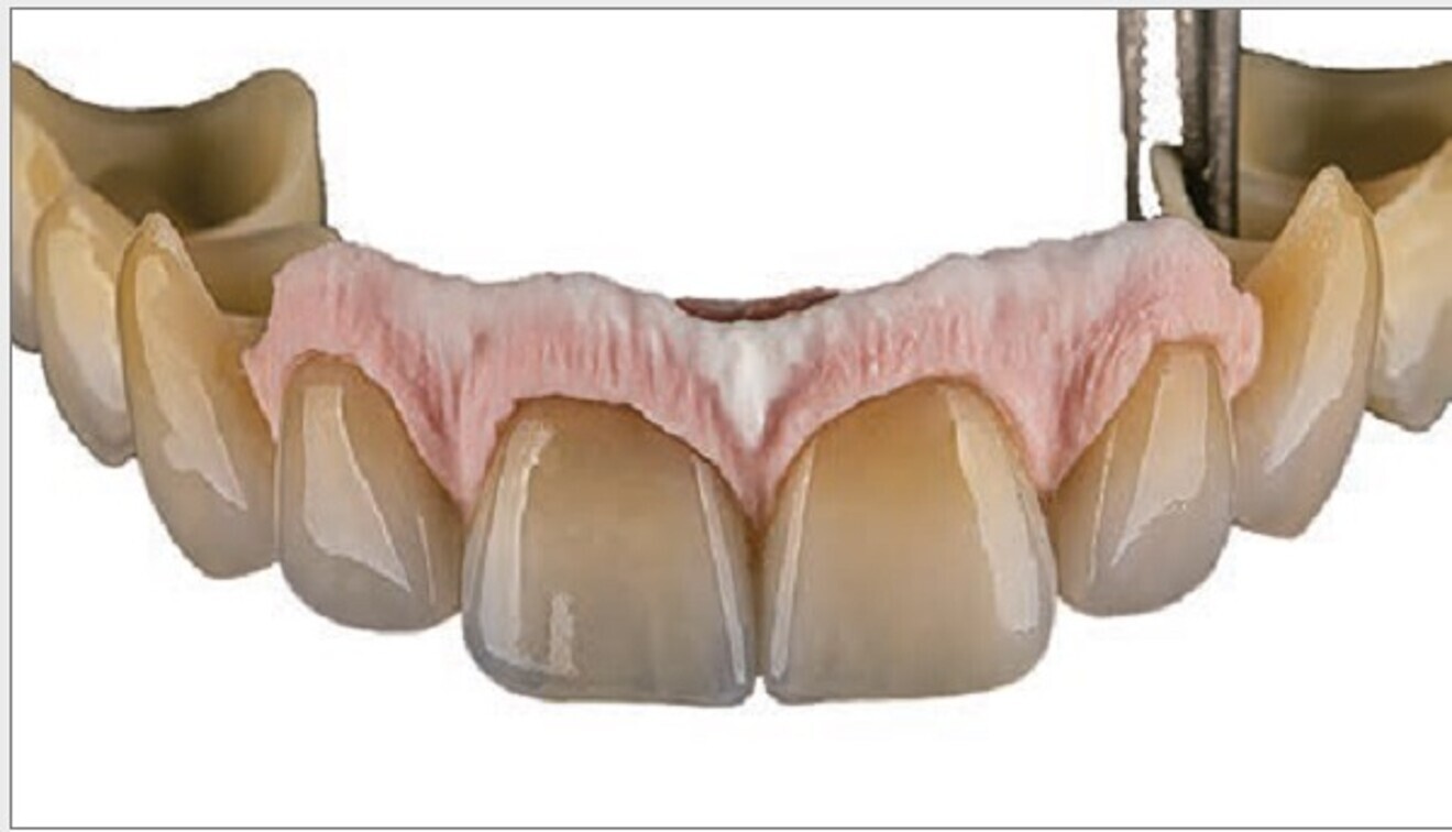 Application of CERABIEN MiLai tissue porcelains to a complex restoration with the teeth already finalised. (Image: Ioulianos Moustakis)