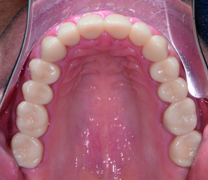 Fig. 11: Post-op retracted view.