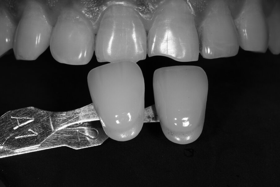 Fig. 2: Black and white photo taken with classic Vita shade guide for value assessment, Shade A2 matches with natural dentition compared to A1
