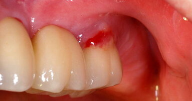 Peri-implantitis: Is it a crisis?