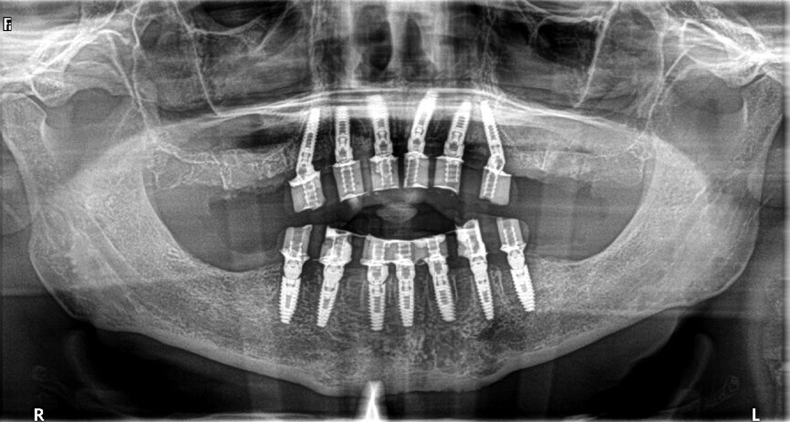 Fig. 20: Post-op panoramic view.