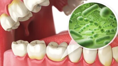 Limiter le contact champignons-bactéries peut réduire les caries chez les enfants