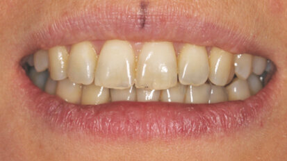 Lingvální zámky 3M™ Incognito™ System a kombinovaná ortodontickochirurgická terapie