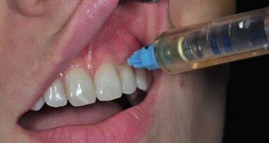 Korak dalje – lokalna anestezija ili paraformaldehid?