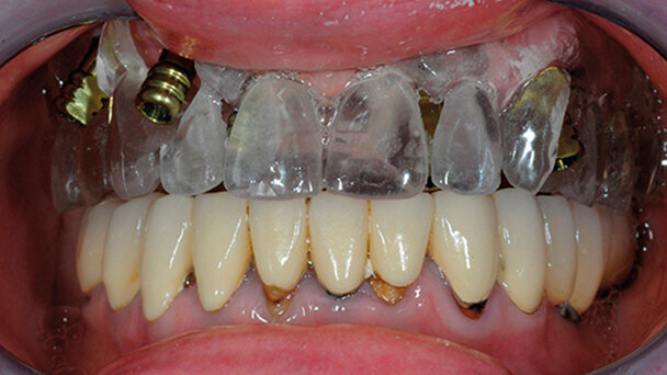 Protesi removibile nell’era del digitale