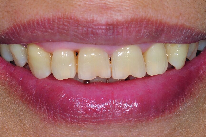 Fig. 6: Frontal smile view pre operation.