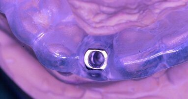 Les années les plus marquantes de l’implantologie - Une rétrospective très personnelle