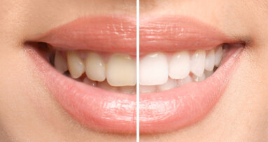 Beyond cosmetics to care: Biocompatible tooth whitening