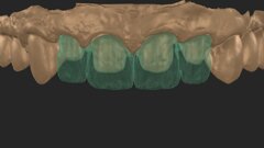A smooth path towards beautiful smiles: Micro-layering with CERABIEN MiLai