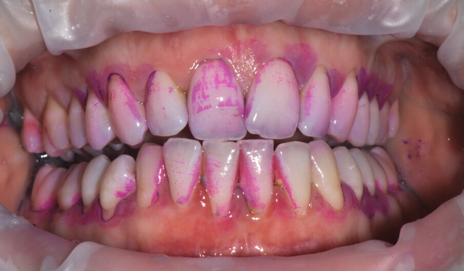 Figg. 1a-1c - Applicazione del rilevatore di placca che verrà usato come guida durante la terapia, nel versante vestibolare (1a), palatale (1b) e linguale (1c). Si noti lo scarso livello di igiene orale domiciliare e l’assenza di utilizzo dei presidi interdentali.