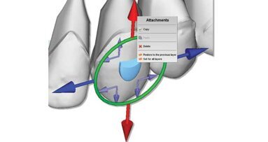 Storing ortho models digitally saves space, dollars