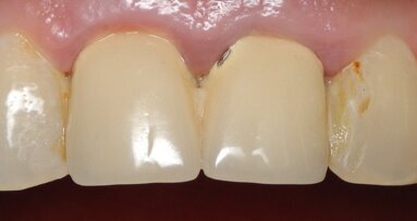 Same-day dentistry: Replacement of two PFM crowns with zirconia restorations